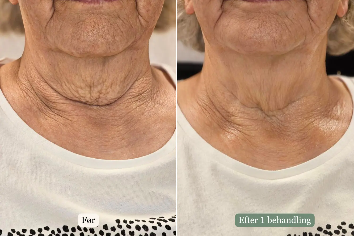 Før og efter HIFU-behandling — Hals