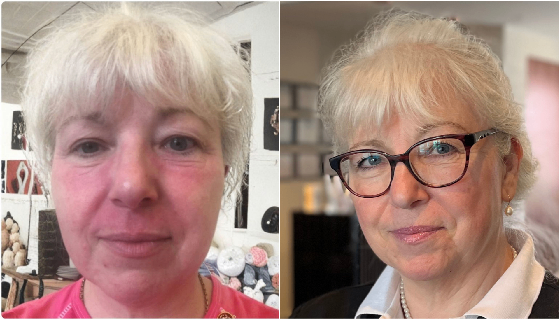 Lise-Lottes egen rejse med rosacea — før og efter