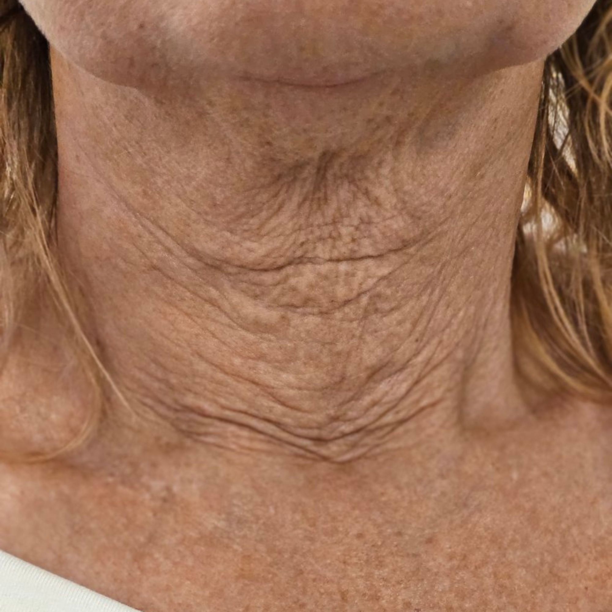 Hals — efter
