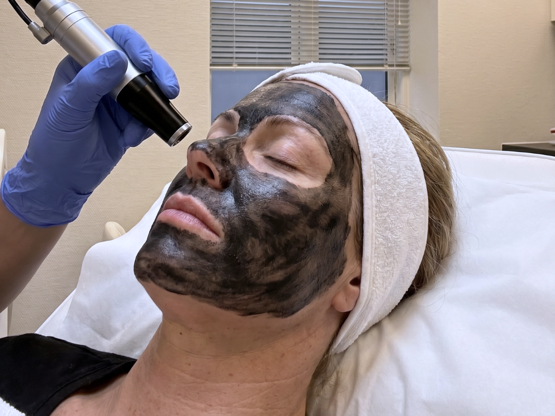 Hollywood Peeling med carbon-maske og laser hos Beautiful Balance
