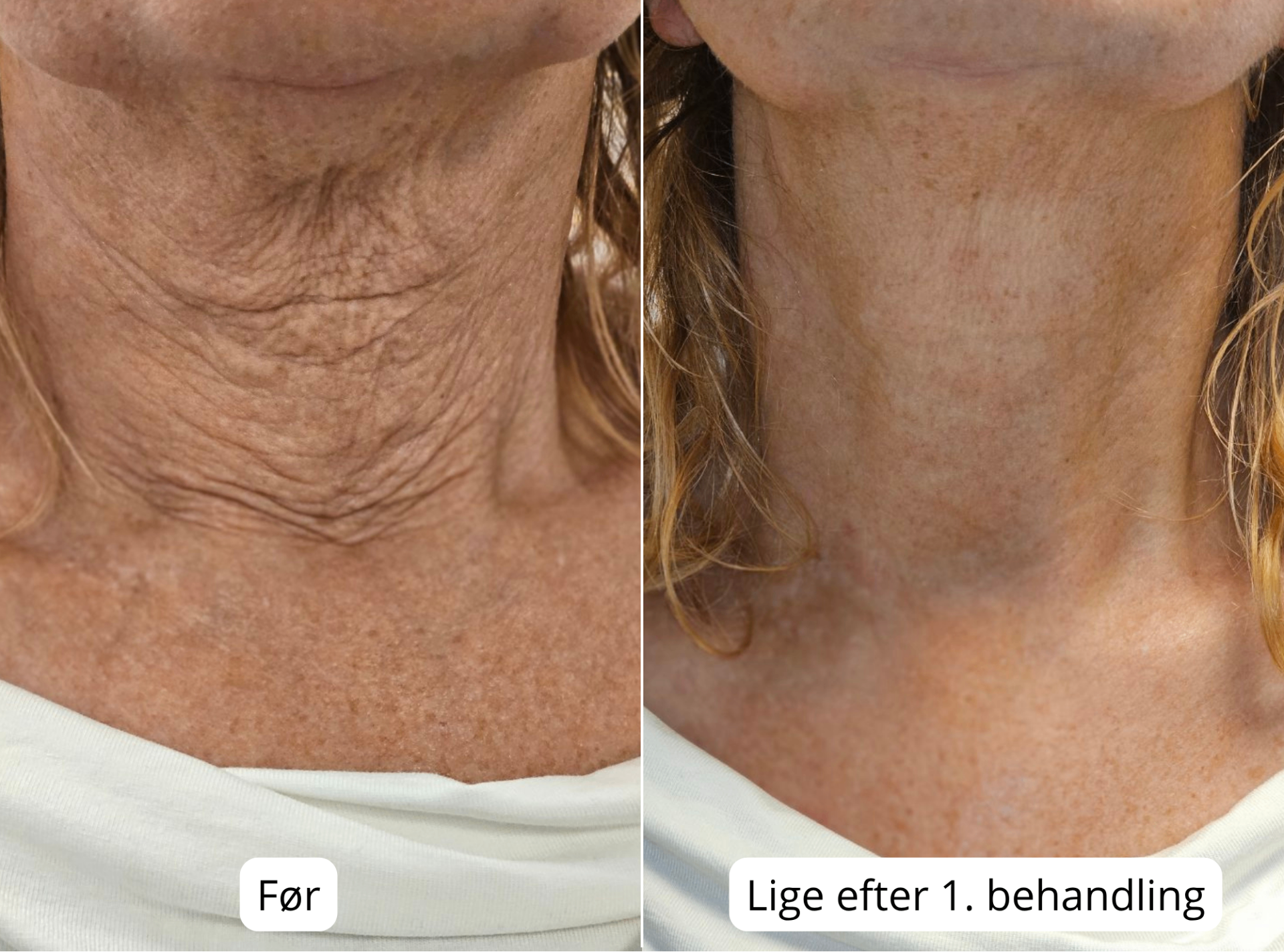 Før og lige efter 1. behandling — synlig forandring på halsen