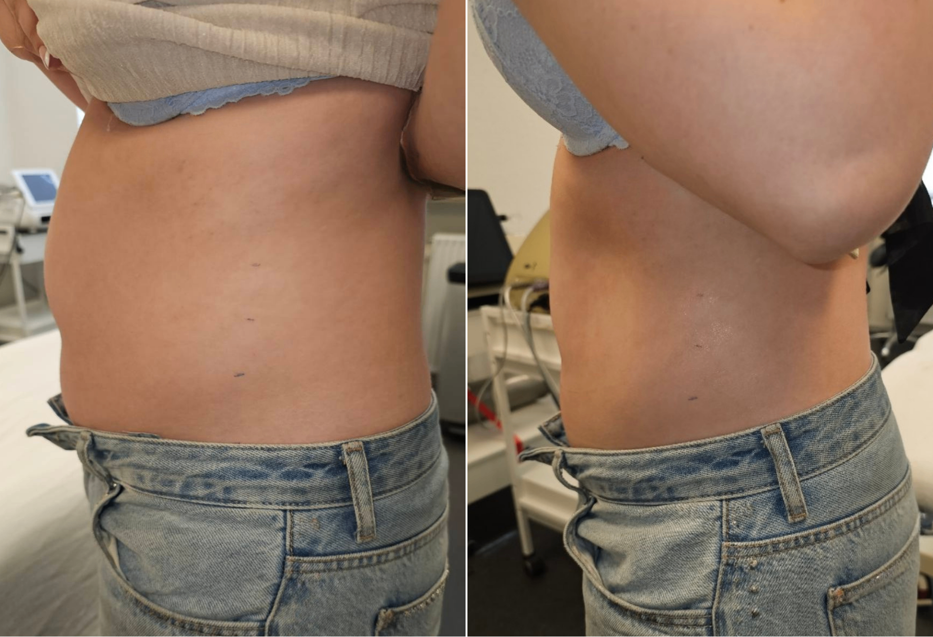Før og efter HIFU PRO behandling på mave og side — 15,5 cm reduktion rundt om livet efter én behandling